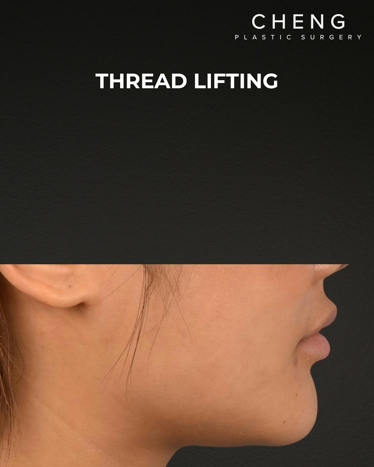 Thread Lifting Before & After Gallery - Patient 132694 - Image 6