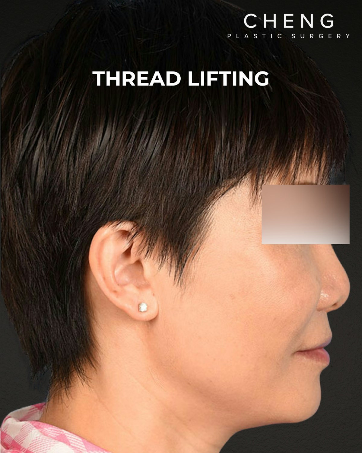 Thread Lifting Before & After Gallery - Patient 285819 - Image 4