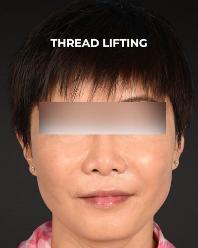 Thread Lifting Before & After Gallery - Patient 285819 - Image 2
