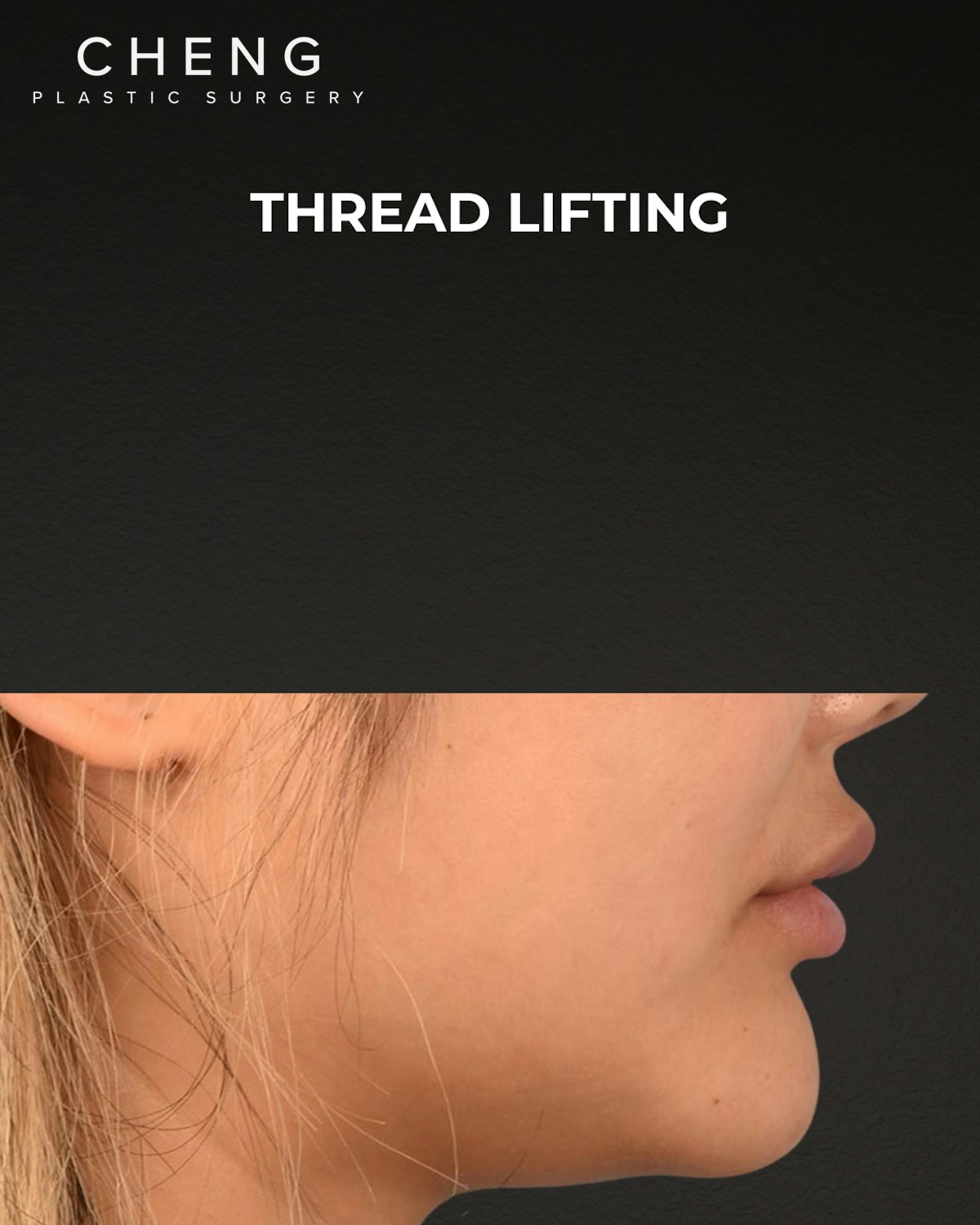 Thread Lifting Before & After Gallery - Patient 132694 - Image 5