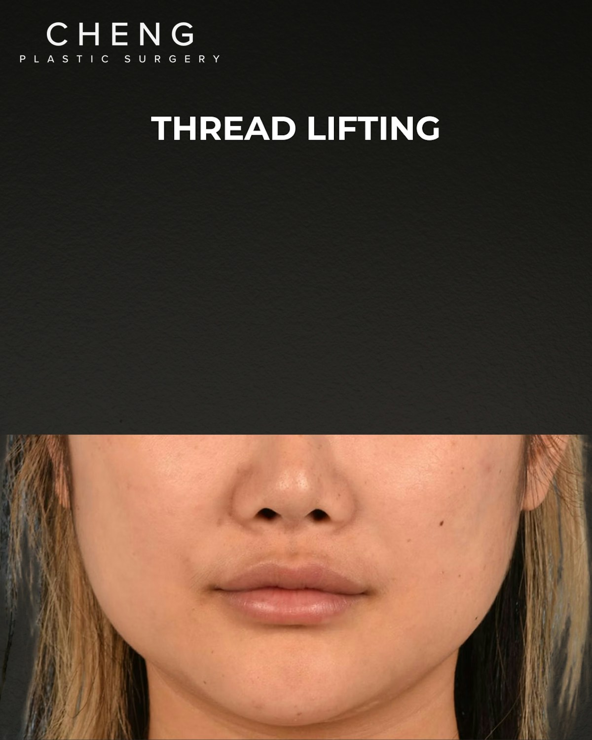 Thread Lifting Before & After Gallery - Patient 132694 - Image 1
