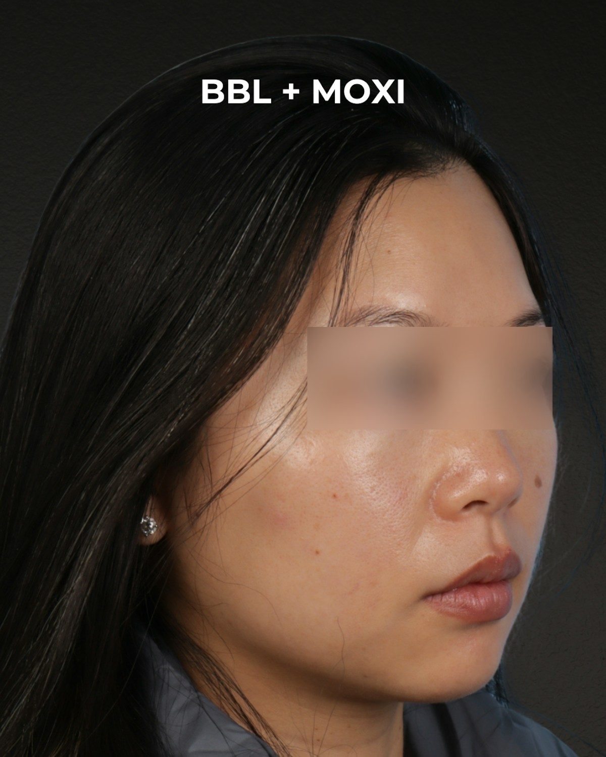 Pigment Laser Before & After Gallery - Patient 356417 - Image 5