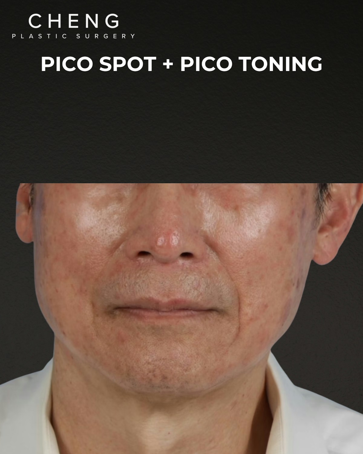 Pigment Laser Before & After Gallery - Patient 297186 - Image 1