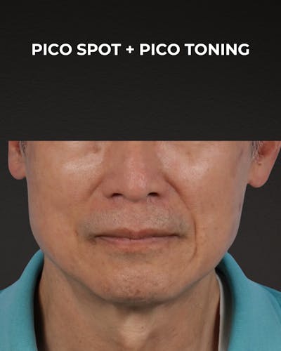 Pigment Laser Before & After Gallery - Patient 297186 - Image 2