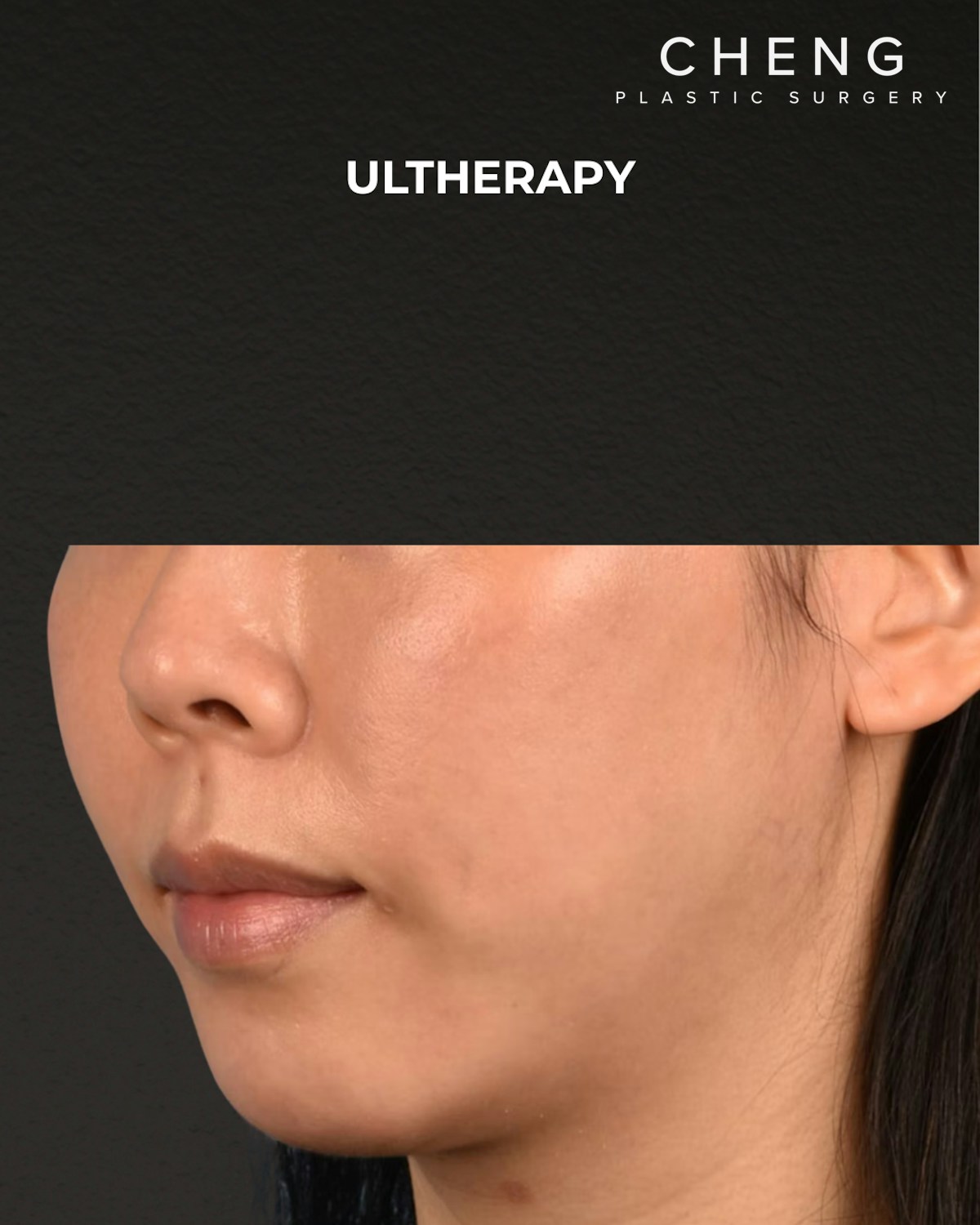 Ultherapy Before & After Gallery - Patient 134425 - Image 4