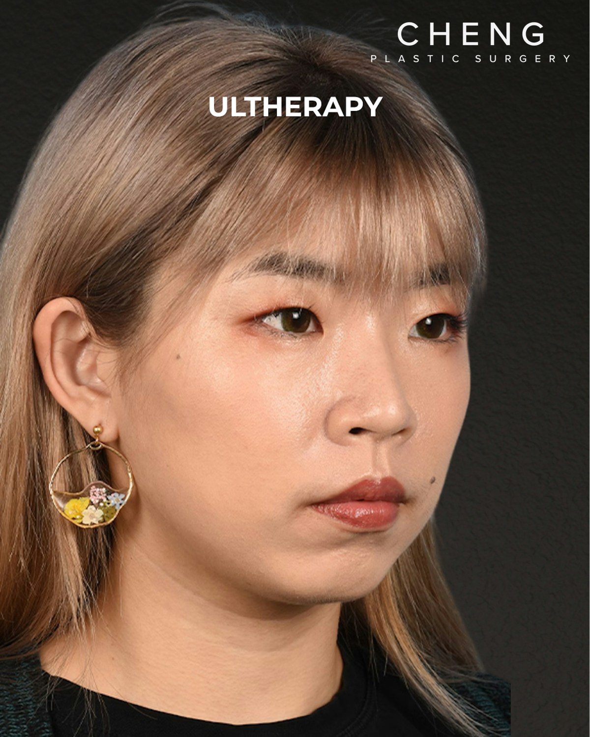 Ultherapy Before & After Gallery - Patient 103120 - Image 4