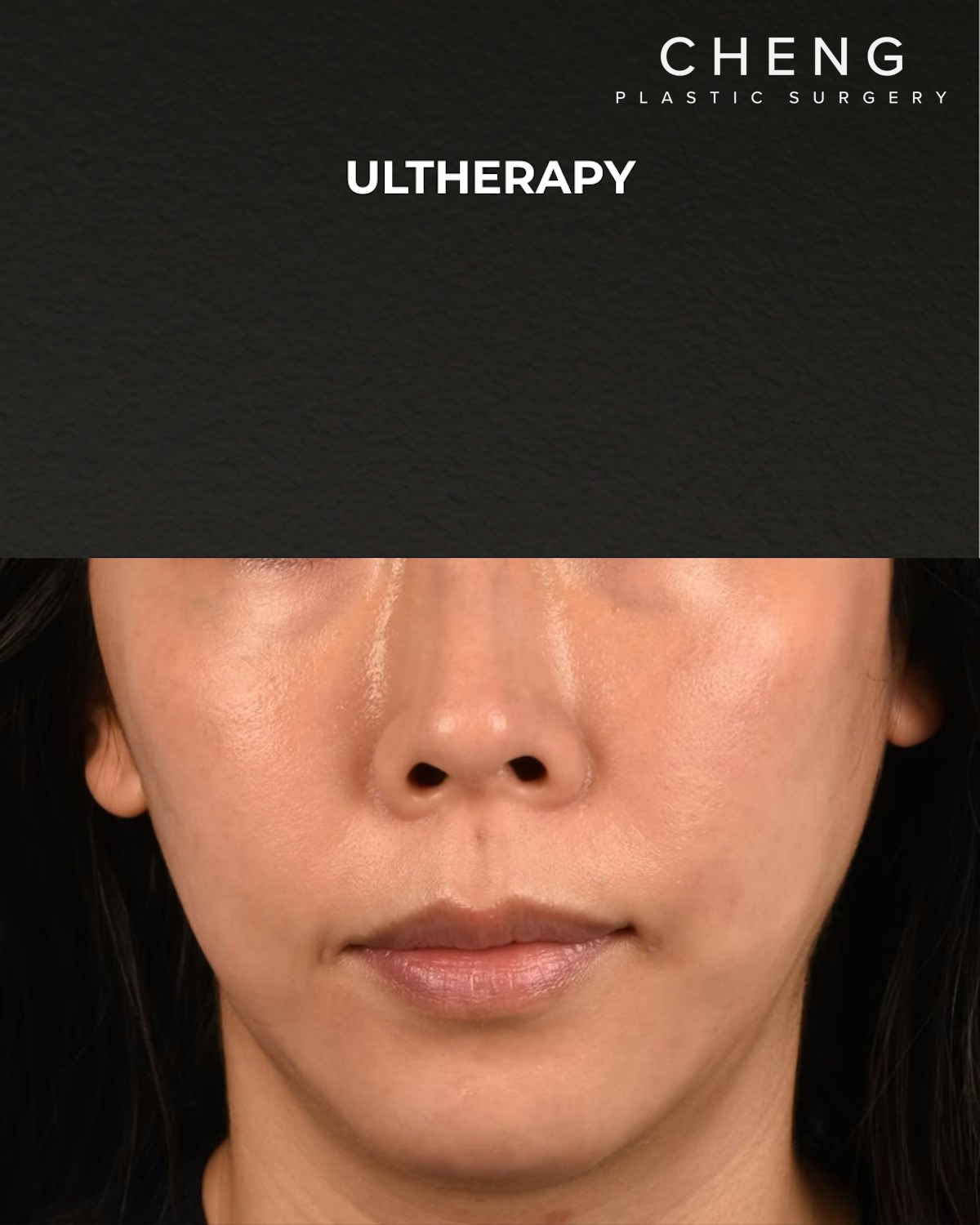 Ultherapy Before & After Gallery - Patient 134425 - Image 2