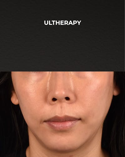 Ultherapy Before & After Gallery - Patient 134425 - Image 2