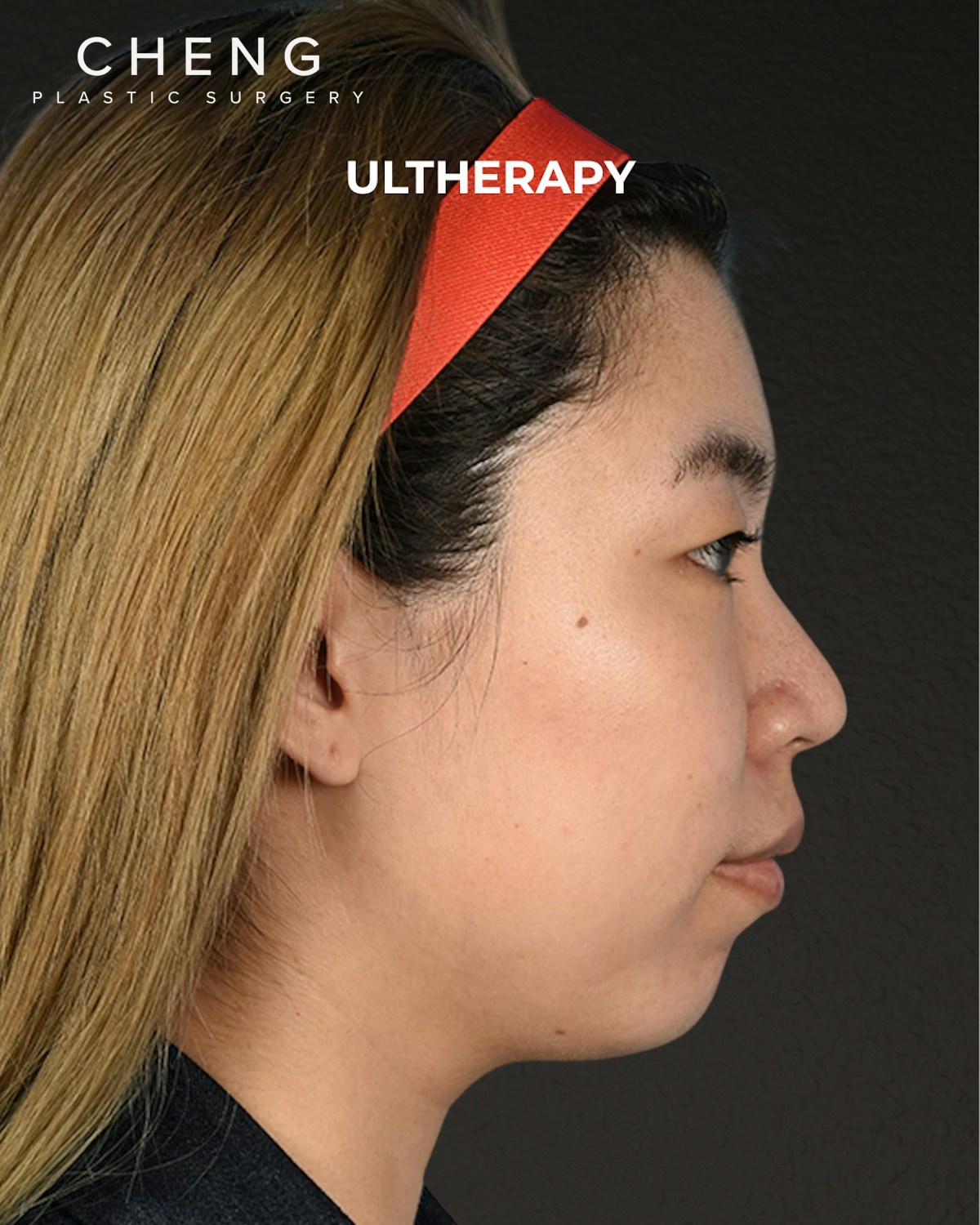 Ultherapy Before & After Gallery - Patient 103120 - Image 5