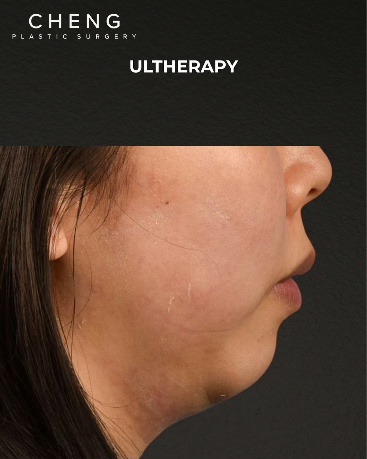 Ultherapy Before & After Gallery - Patient 134425 - Image 7