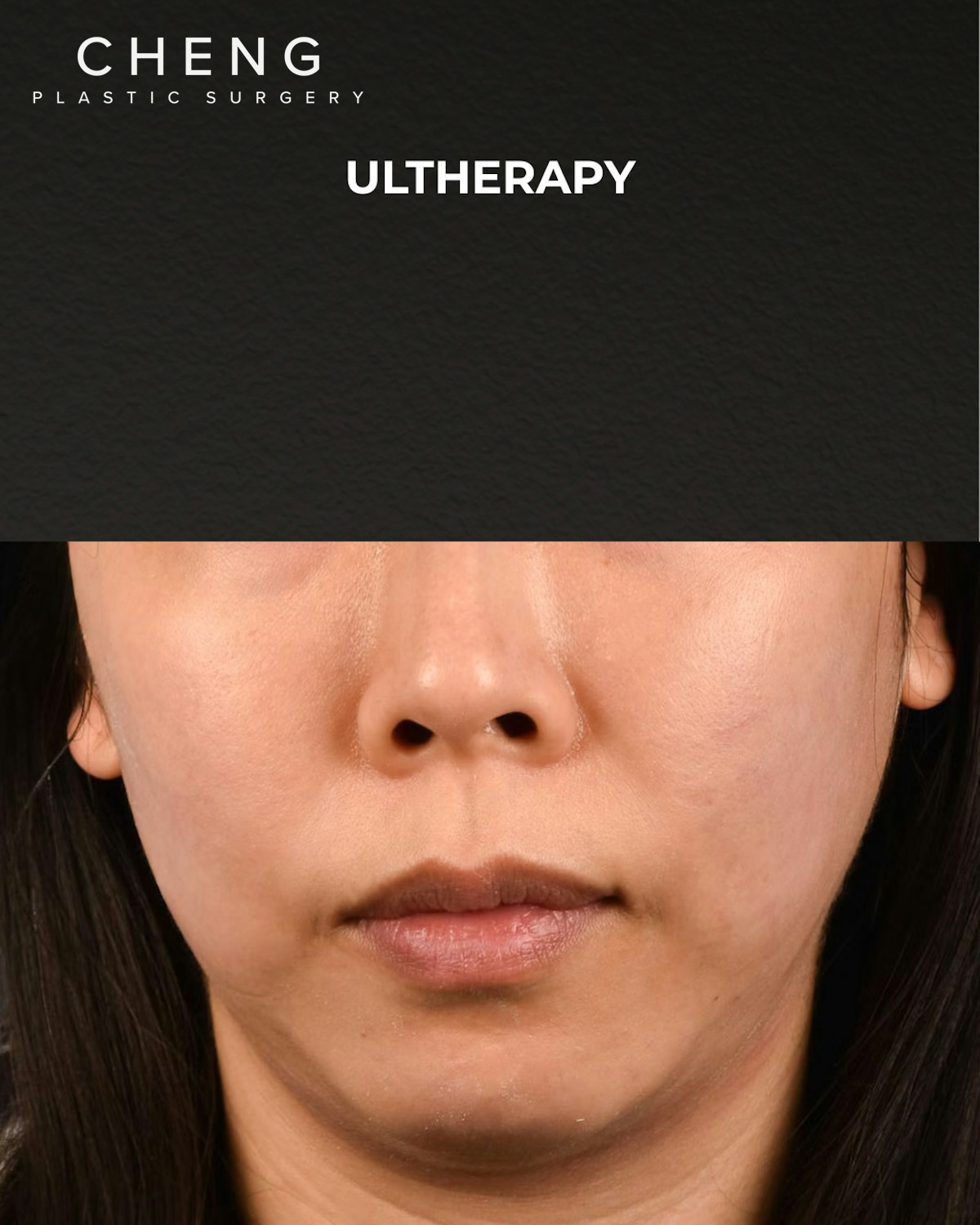 Ultherapy Before & After Gallery - Patient 134425 - Image 1