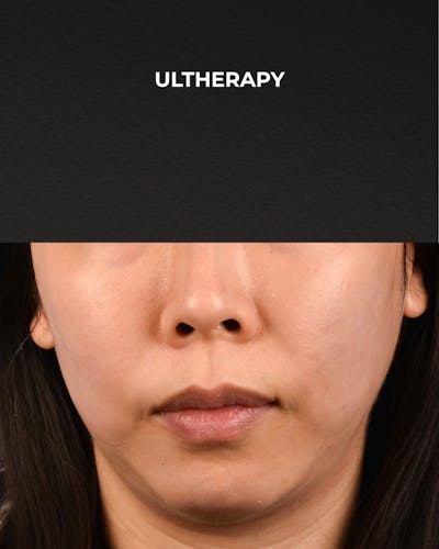 Ultherapy Before & After Gallery - Patient 134425 - Image 1