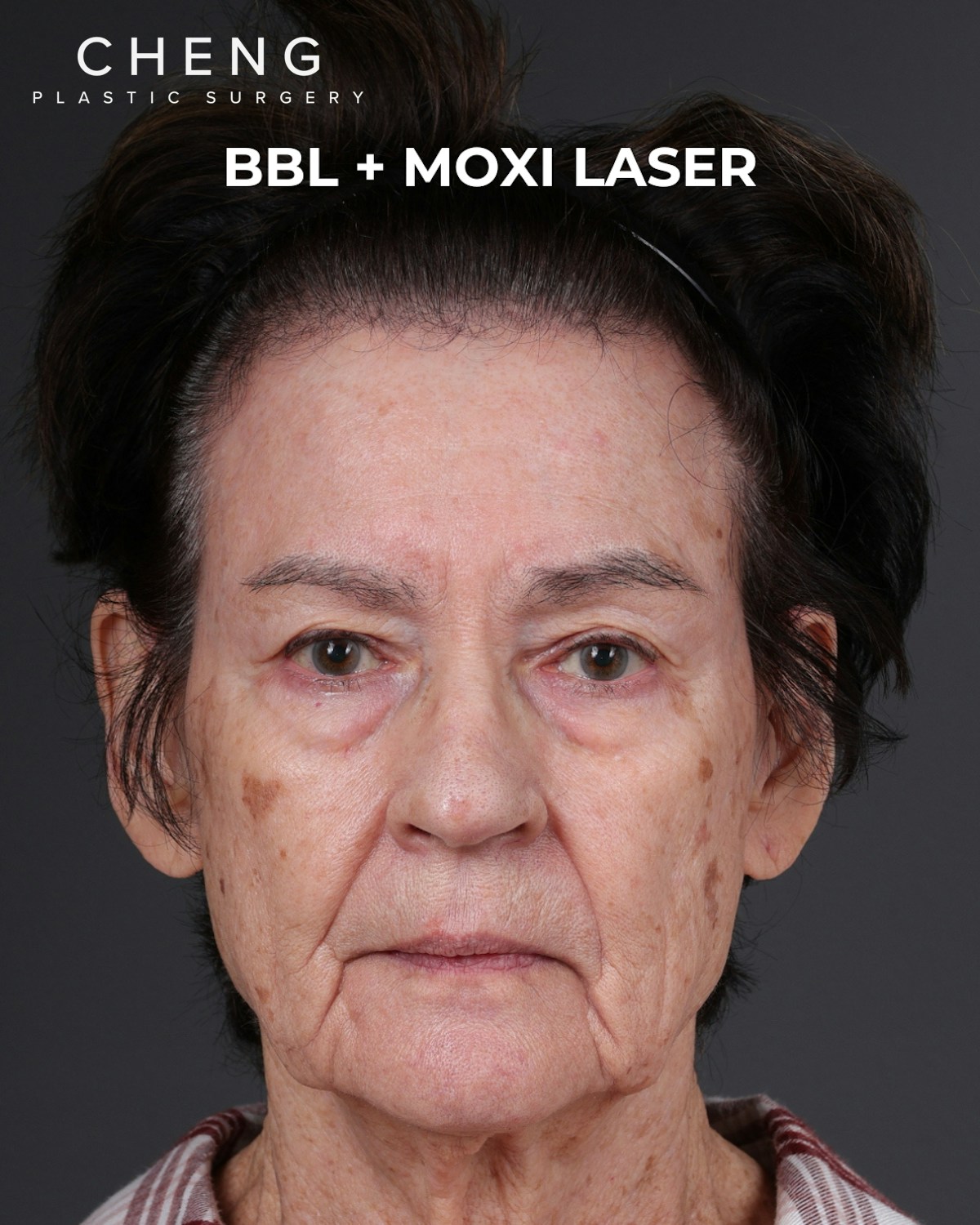 Pigment Laser Before & After Gallery - Patient 182306 - Image 1