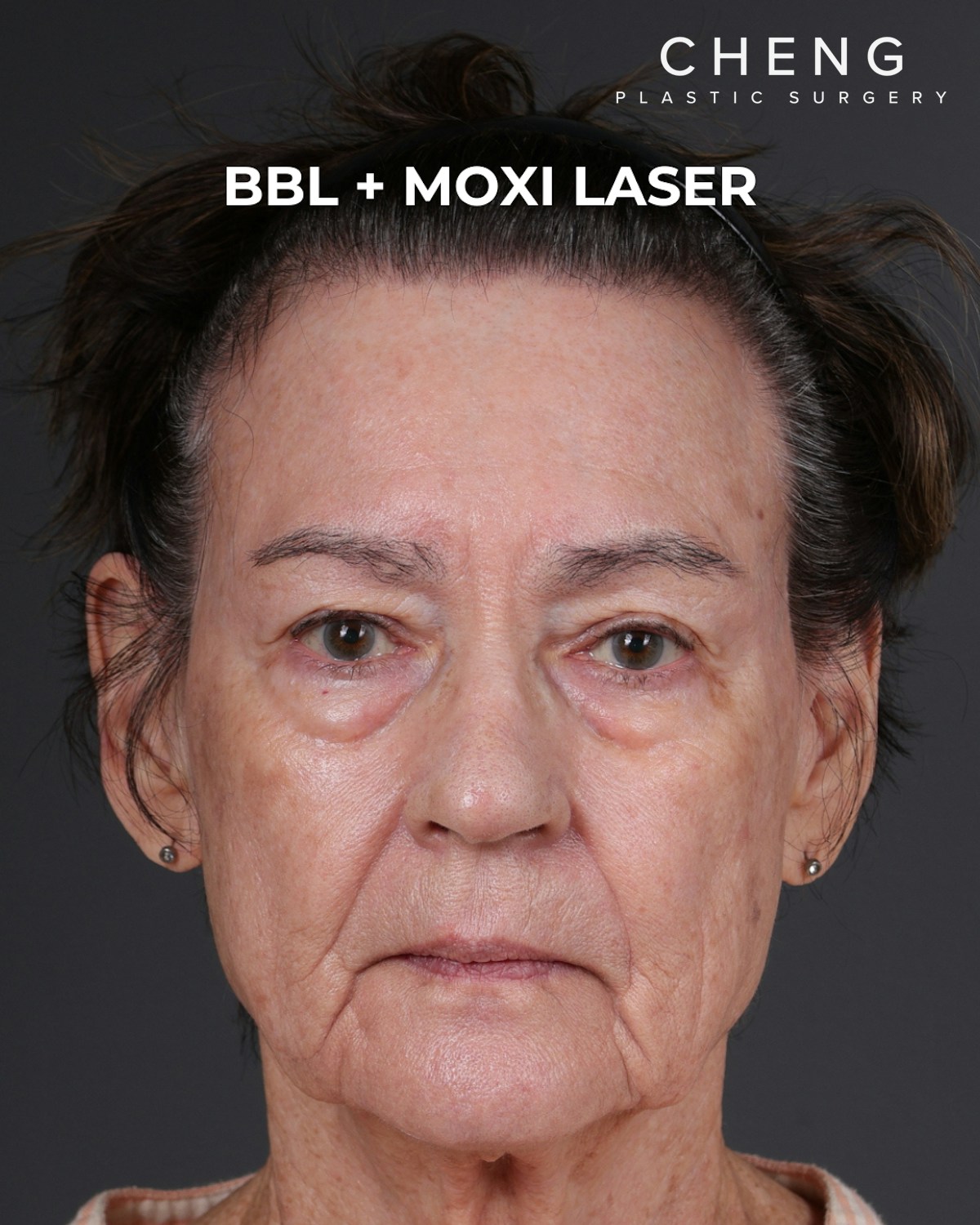 Pigment Laser Before & After Gallery - Patient 182306 - Image 2