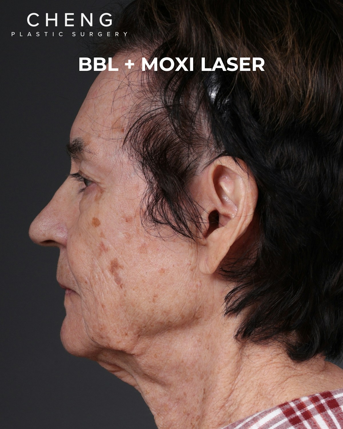 Pigment Laser Before & After Gallery - Patient 182306 - Image 5
