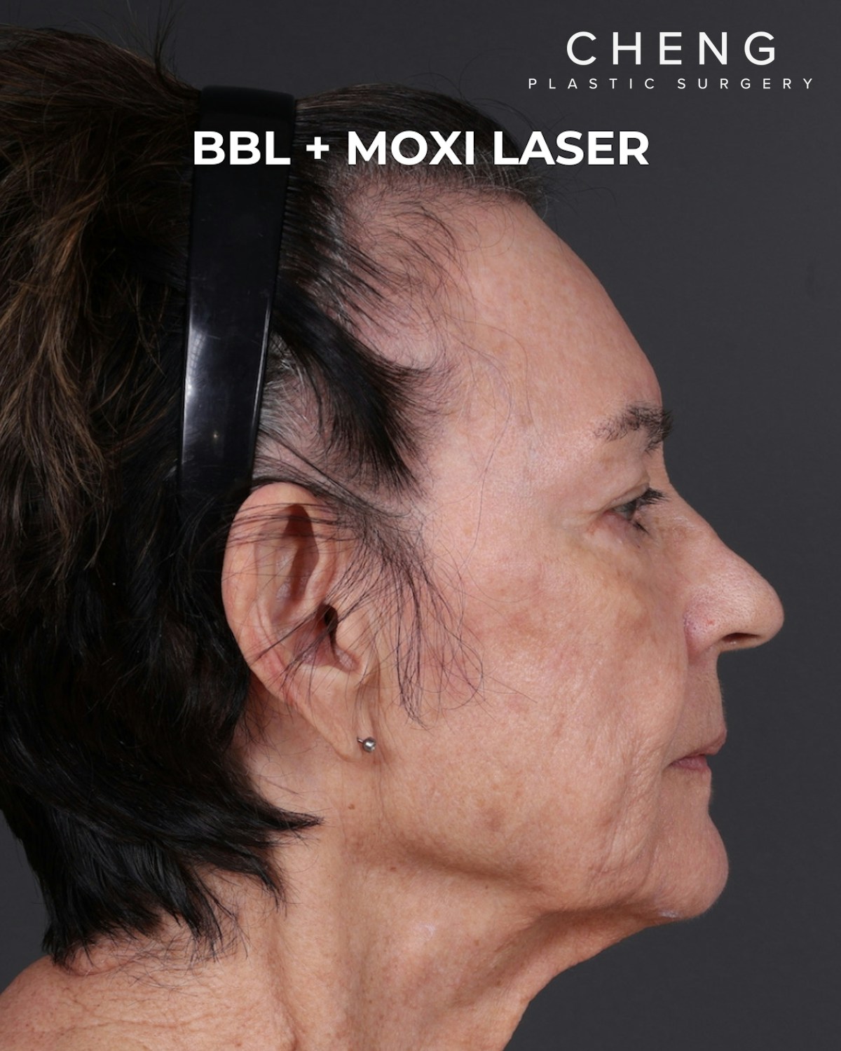 Pigment Laser Before & After Gallery - Patient 182306 - Image 8