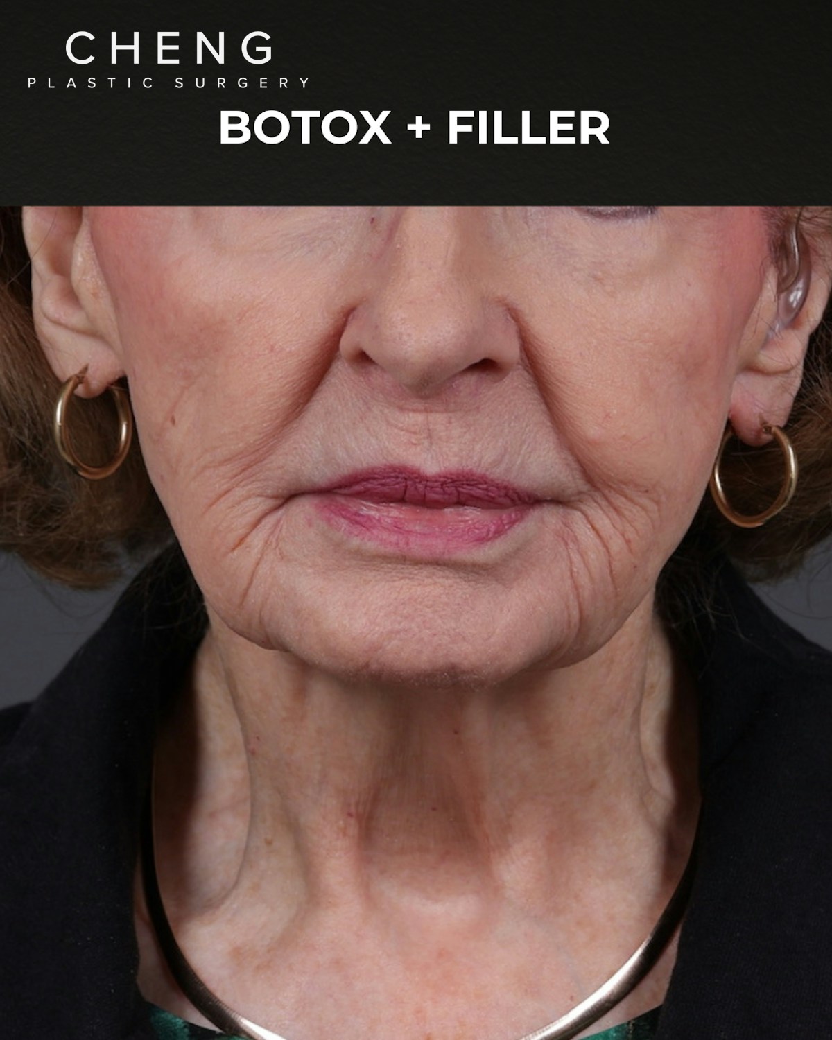 Dermal Fillers Before & After Gallery - Patient 742636 - Image 1