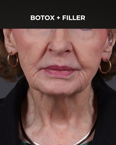 Dermal Fillers Before & After Gallery - Patient 742636 - Image 1