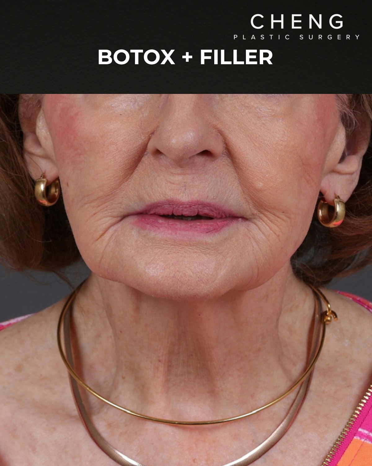 Dermal Fillers Before & After Gallery - Patient 742636 - Image 2