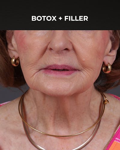 Dermal Fillers Before & After Gallery - Patient 742636 - Image 2
