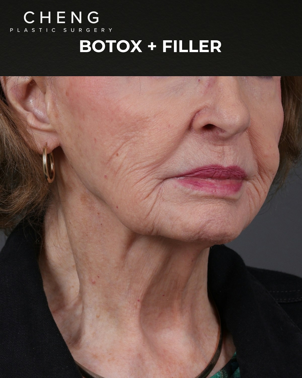Dermal Fillers Before & After Gallery - Patient 742636 - Image 3