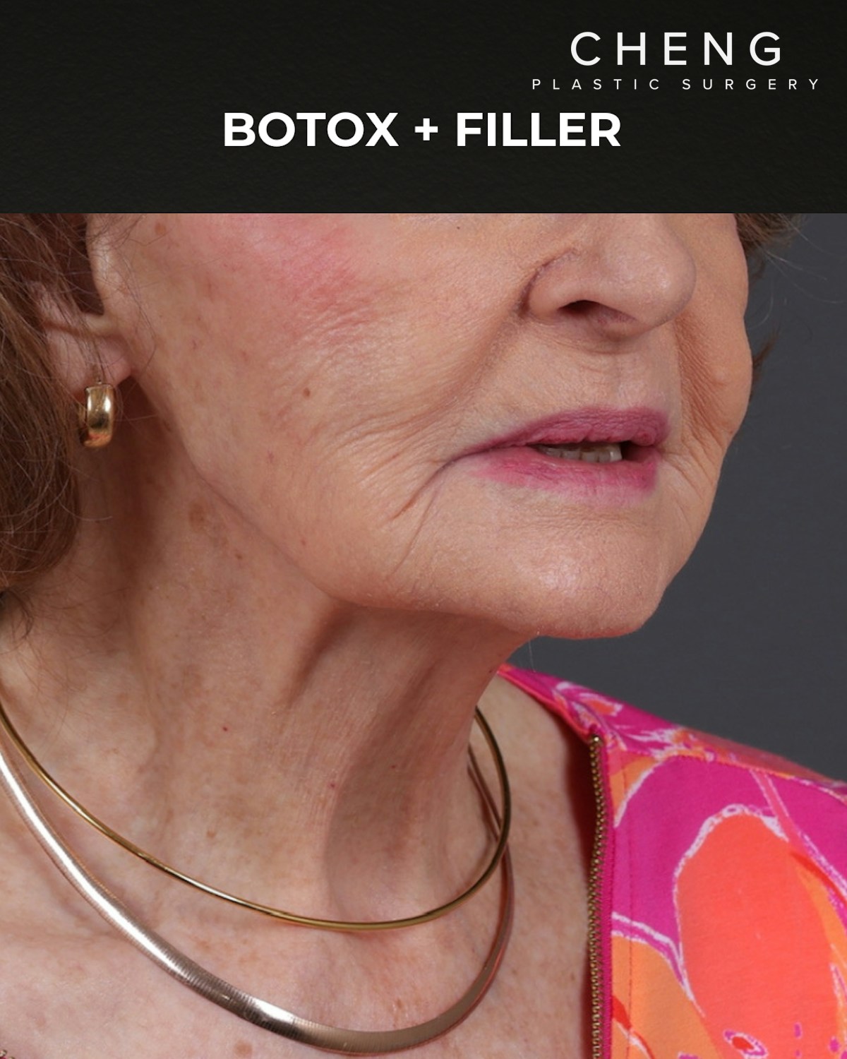 Dermal Fillers Before & After Gallery - Patient 742636 - Image 4