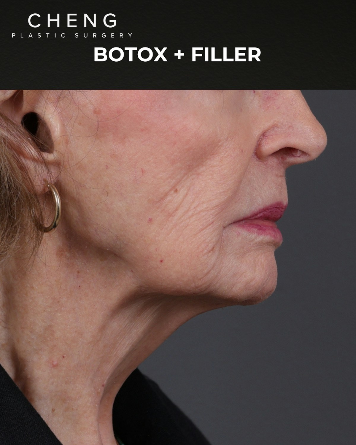 Dermal Fillers Before & After Gallery - Patient 742636 - Image 5