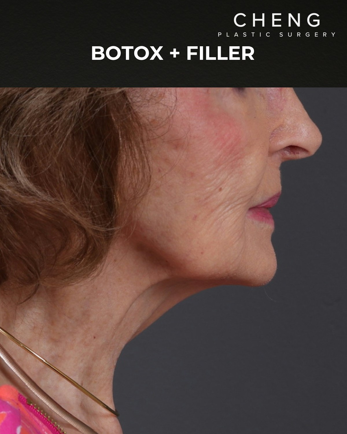 Dermal Fillers Before & After Gallery - Patient 742636 - Image 6
