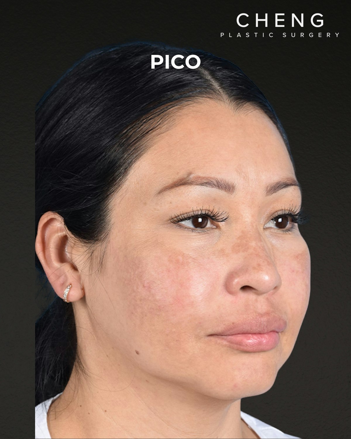 Pigment Laser Before & After Gallery - Patient 555927 - Image 4