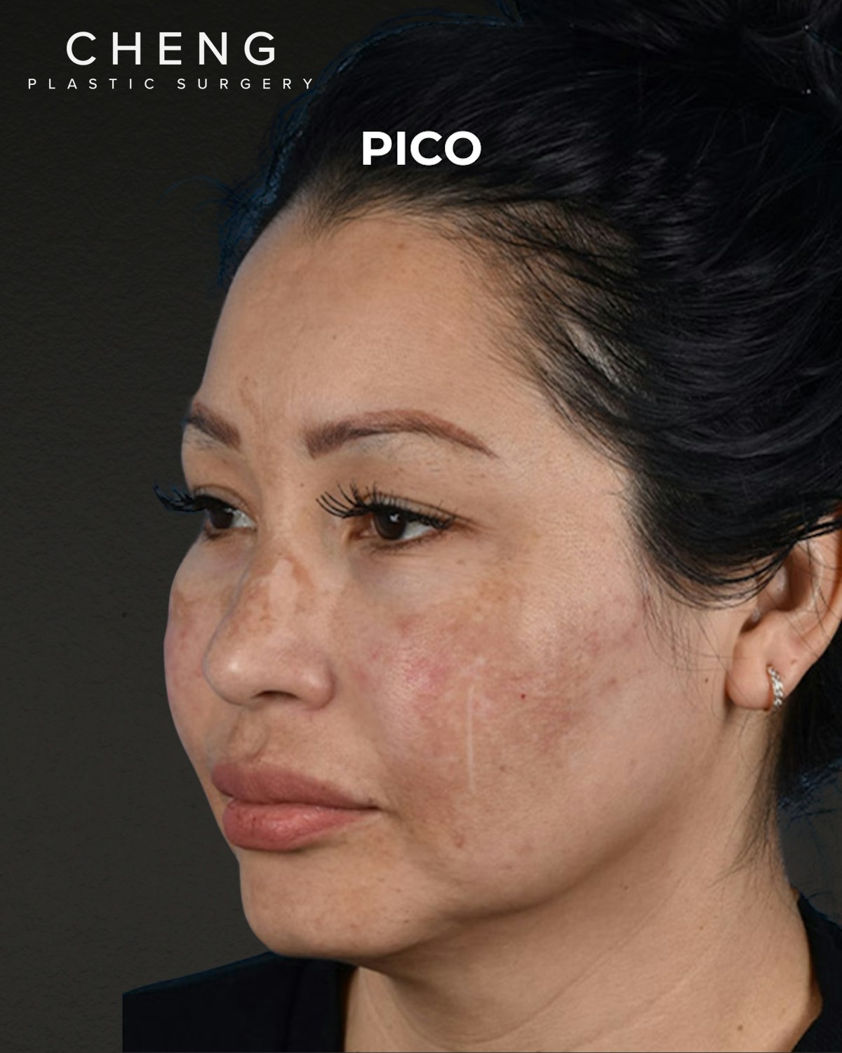 Pigment Laser Before & After Gallery - Patient 555927 - Image 5