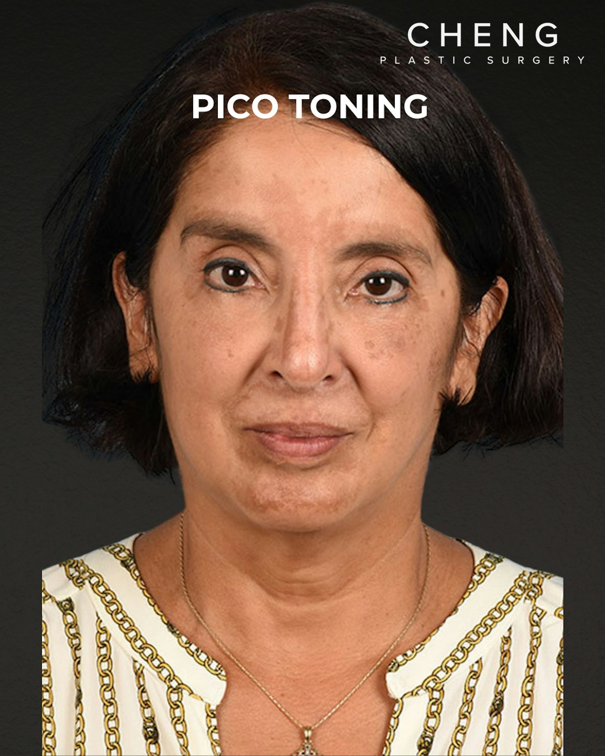 Pigment Laser Before & After Gallery - Patient 210761 - Image 2