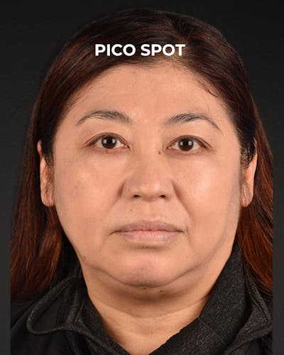 Pigment Laser Before & After Gallery - Patient 332305 - Image 2