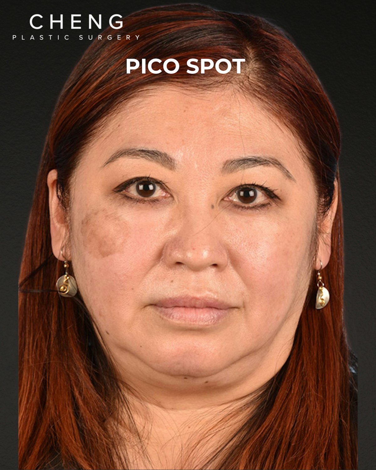 Pigment Laser Before & After Gallery - Patient 332305 - Image 1