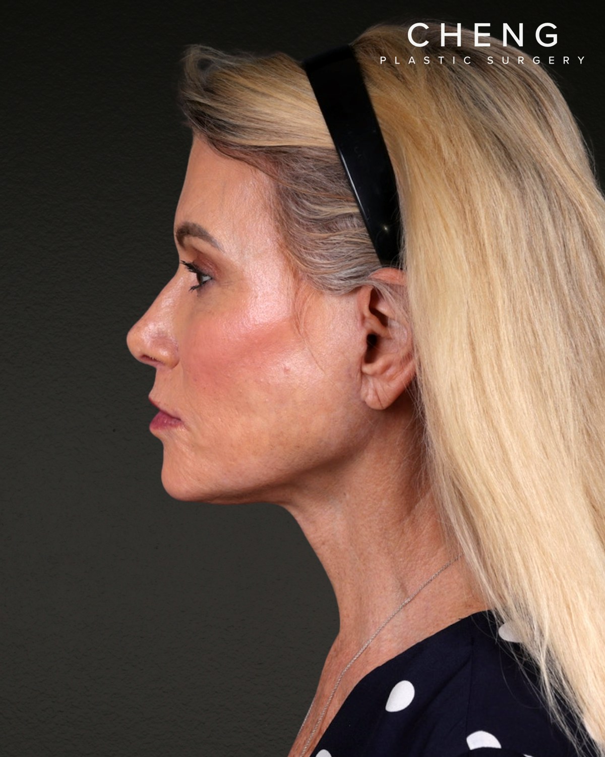 Facelift Before & After Gallery - Patient 105916 - Image 10