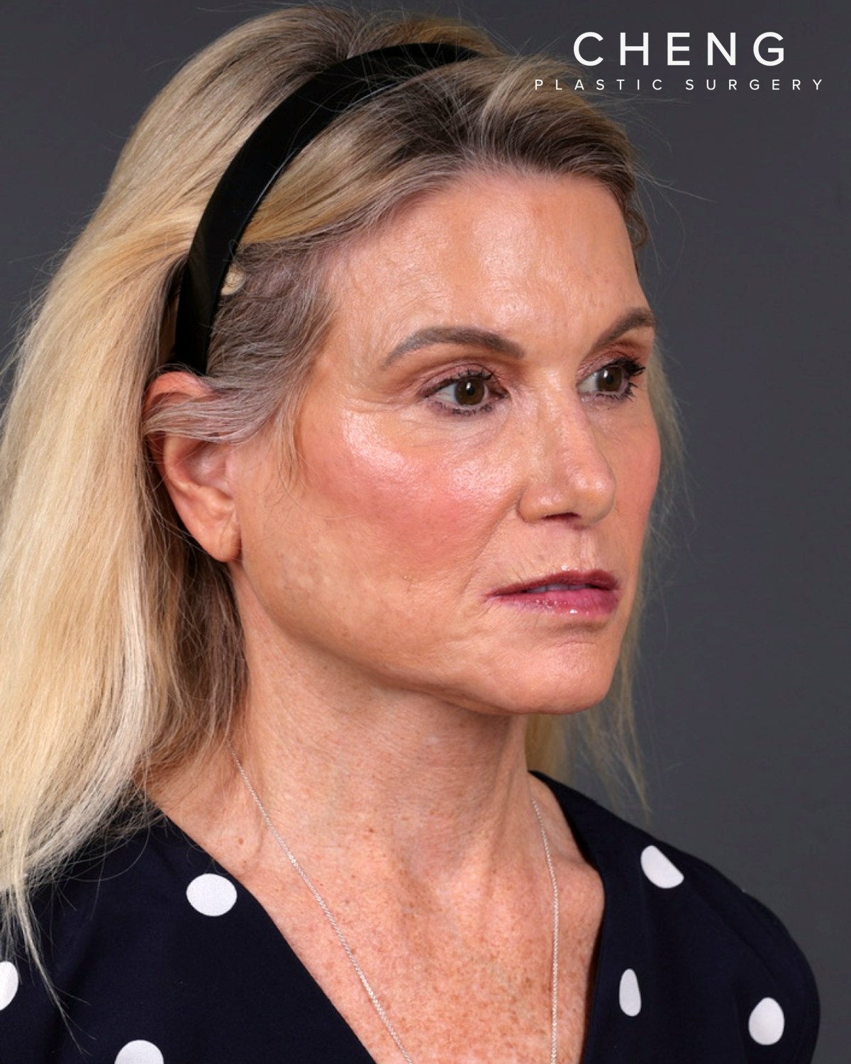 Facelift Before & After Gallery - Patient 105916 - Image 4