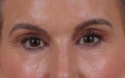 Blepharoplasty Before & After Gallery - Patient 855329 - Image 2