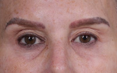 Blepharoplasty Before & After Gallery - Patient 855329 - Image 1