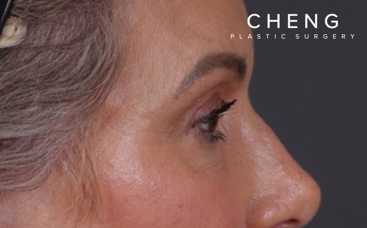 Blepharoplasty Before & After Gallery - Patient 855329 - Image 6