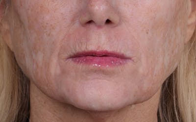 Lip Lift Before & After Gallery - Patient 232096 - Image 1