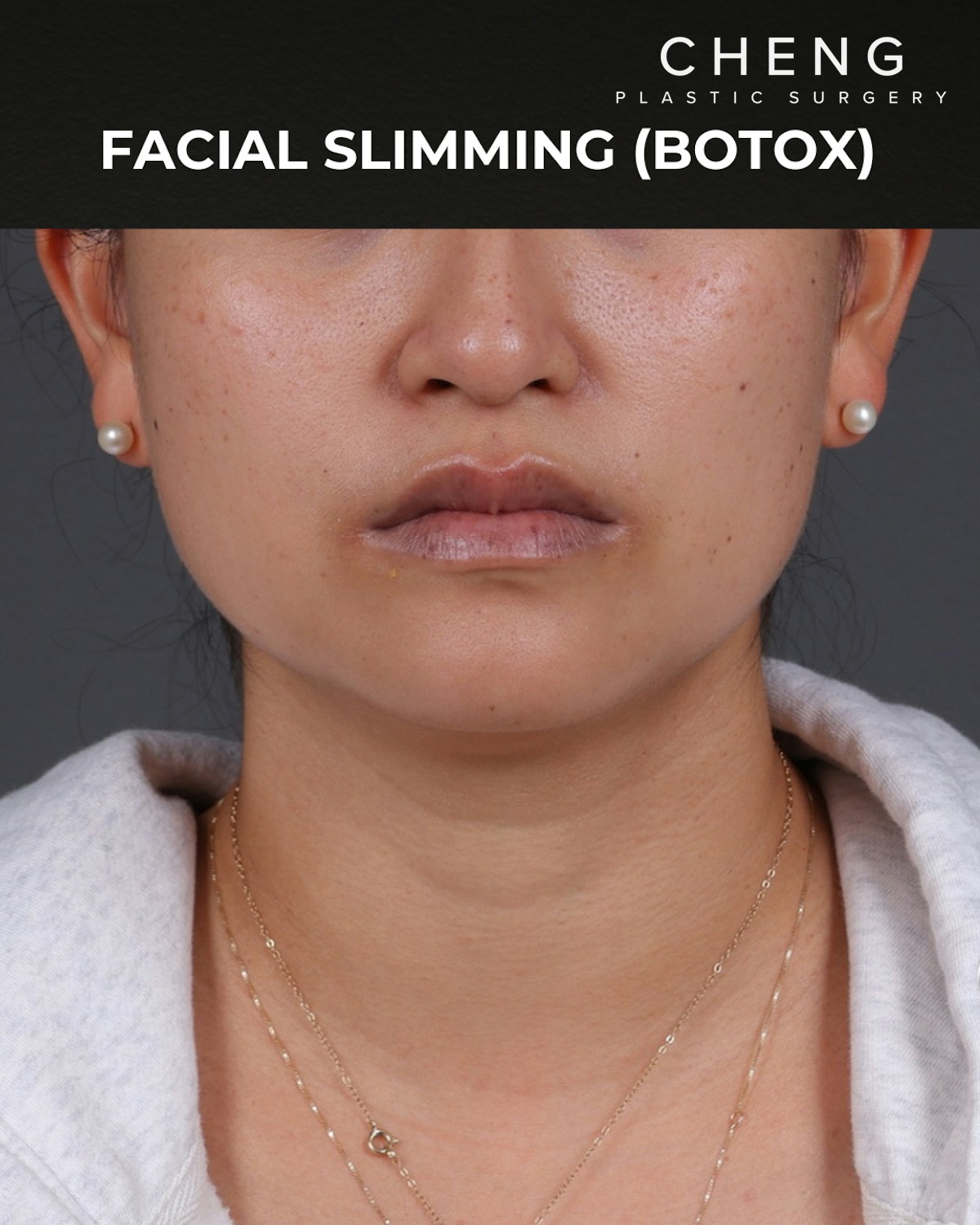 Botox and Dysport Before & After Gallery - Patient 361625 - Image 2