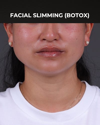 Botox and Dysport Before & After Gallery - Patient 361625 - Image 1