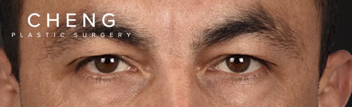 Blepharoplasty Before & After Gallery - Patient 167971 - Image 1