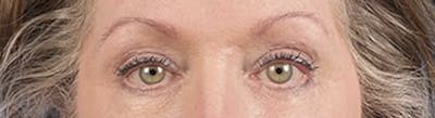 Blepharoplasty Before & After Gallery - Patient 362822 - Image 2