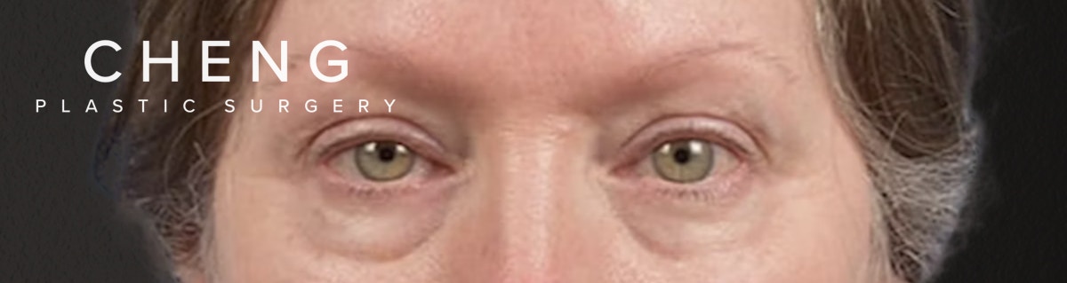 Blepharoplasty Before & After Gallery - Patient 362822 - Image 1
