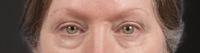 Blepharoplasty Before & After Gallery - Patient 362822 - Image 1