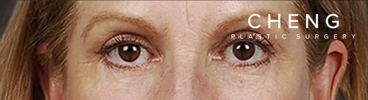 Blepharoplasty Before & After Gallery - Patient 177584 - Image 2