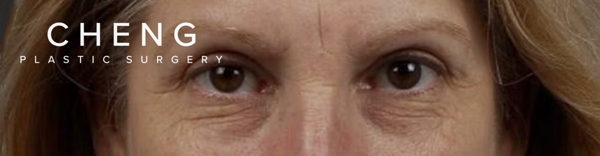 Blepharoplasty Before & After Gallery - Patient 177584 - Image 1