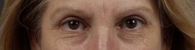Blepharoplasty Before & After Gallery - Patient 177584 - Image 1