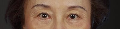 Blepharoplasty Before & After Gallery - Patient 181630 - Image 2