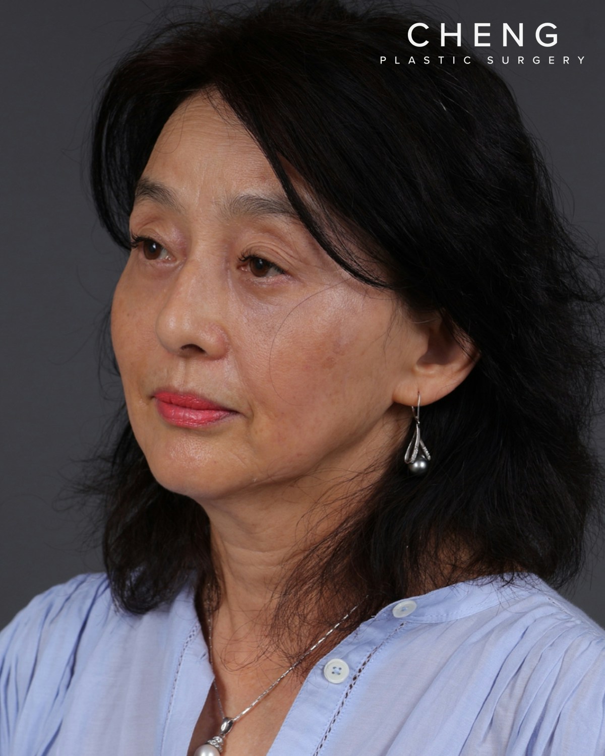 Co2 Laser Before & After Gallery - Patient 377235 - Image 4